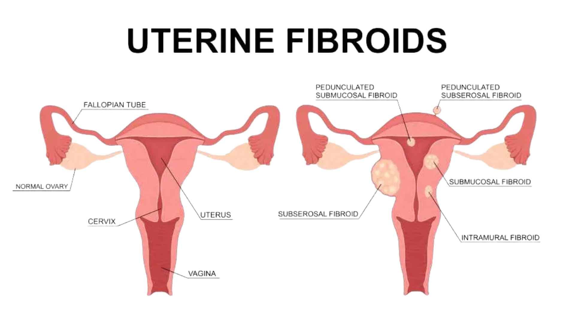 Fibroids During Pregnancy: Risks, Symptoms & Yoga Management